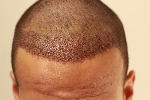 Os cabelos caem depois do implante capilar?