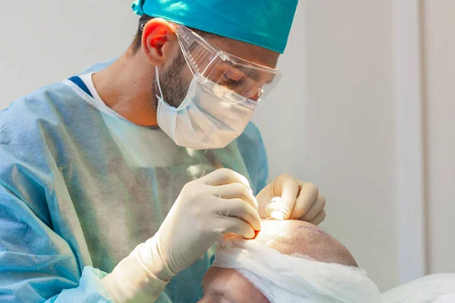Os Perigos de Realizar Implante Capilar em Clínicas Populares Sem Atuação Médica