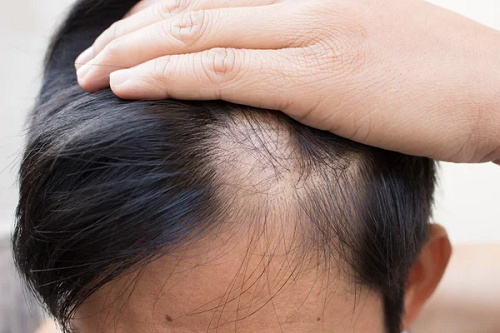Por que precisamos falar sobre alopecia com mais frequência?