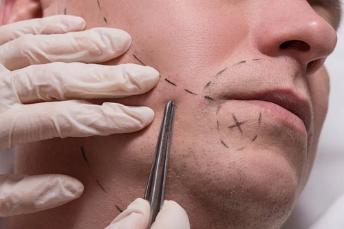 Transplante de barba: como funciona e quais suas vantagens?